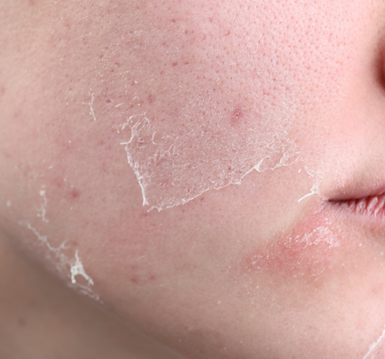 Dry Skin: Hydrate & Nourish for Lasting Comfort